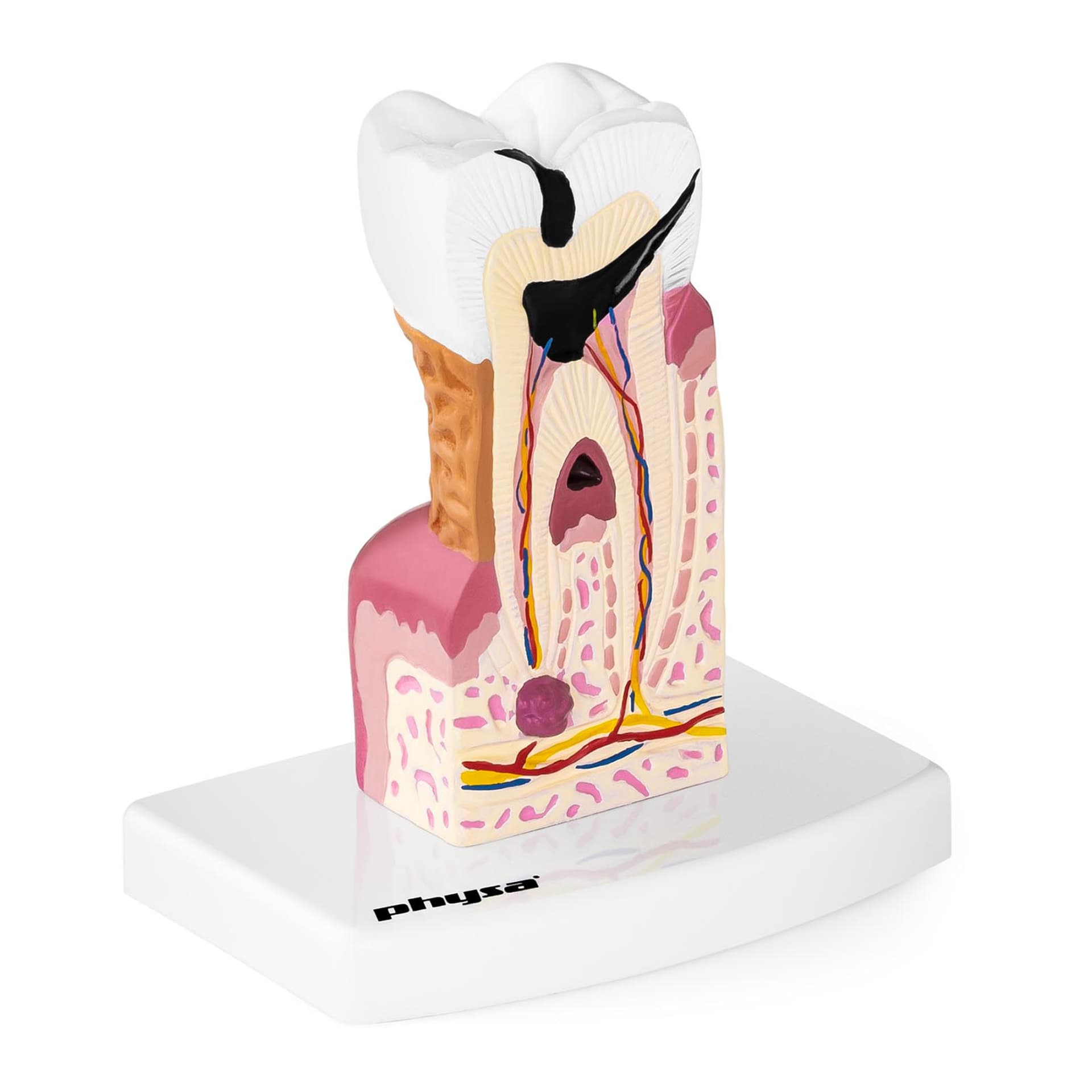 

Model anatomiczny chorego zęba człowieka w skali 6:1
