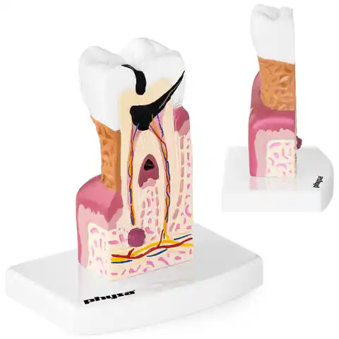 ⁨Model anatomiczny chorego zęba człowieka w skali 6:1⁩ w sklepie Wasserman.eu