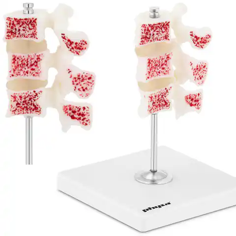 ⁨Model anatomiczny 3D osteoporozy lędźwiowej kręgi 3-5⁩ w sklepie Wasserman.eu