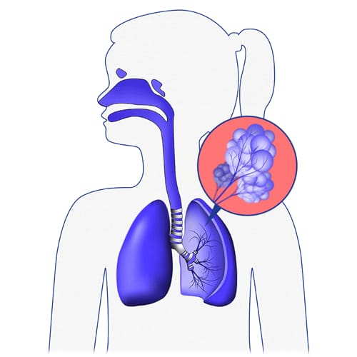 FLAEM ALPHANEB 4.0 Inhalator pneumatyczno-tłokowy z nebulizatorem RF9