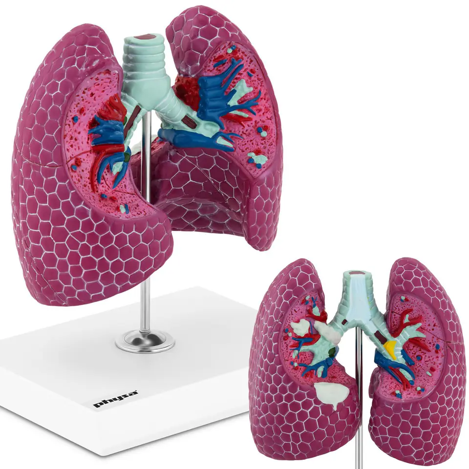 3D anatomical model of human lungs with lesions | Wasserman.eu