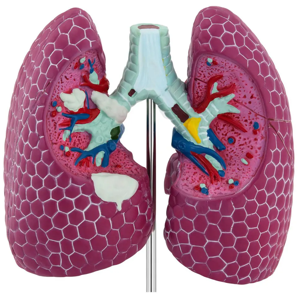 3D anatomical model of human lungs with lesions | Wasserman.eu